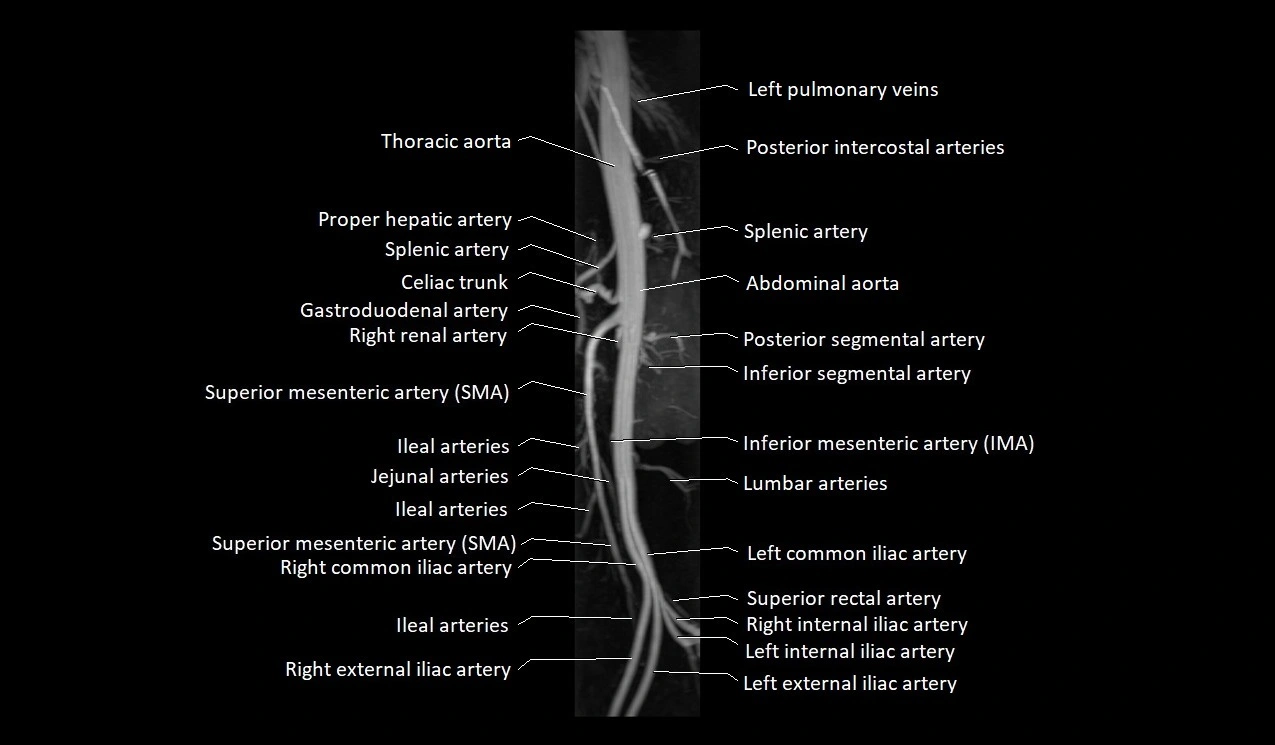 MRA abdomen (renal and mesenteric) angiography MIP 3D anatomy image 6.webp